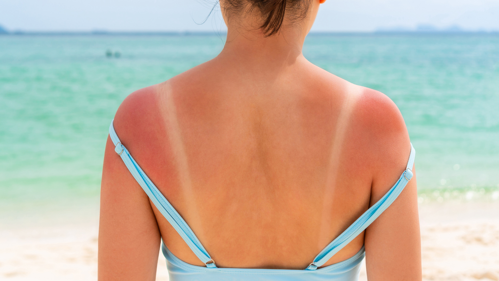 STOP BLAMING THE SUN: It Was the Seed Oils All Along